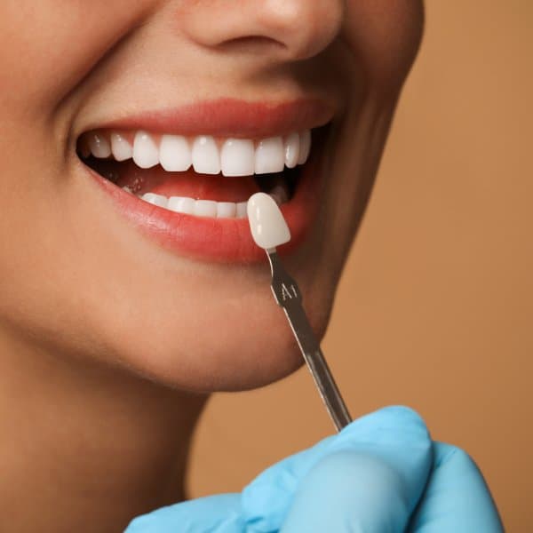 Dental Veneers