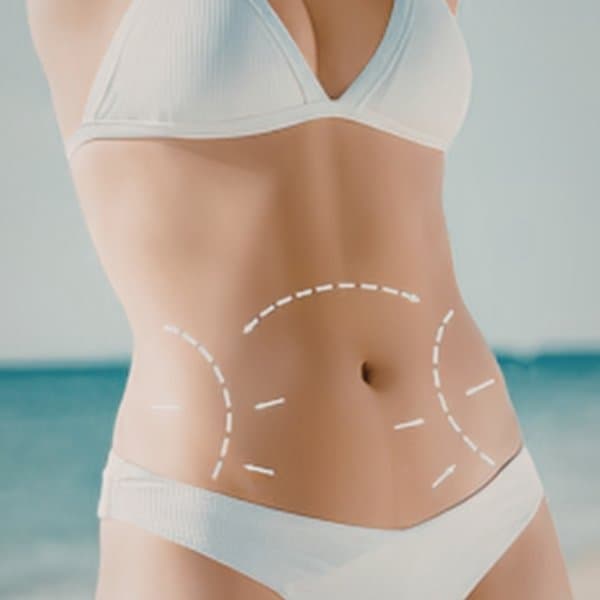 Tummy Tuck